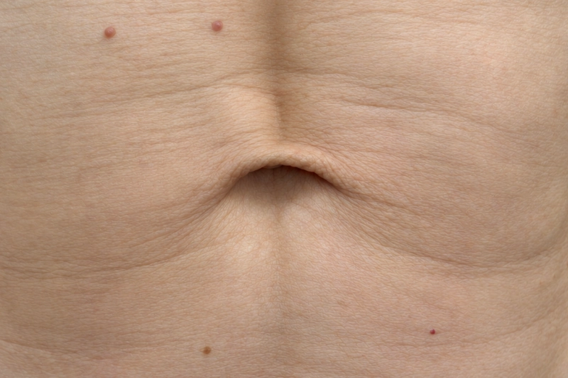 Ausschnittes Bauchregion rund um den Bauchnabel mit sichtbarer Rectusdiastase durch schlaffen Bauchnabel und ausgeprägte Mittelline